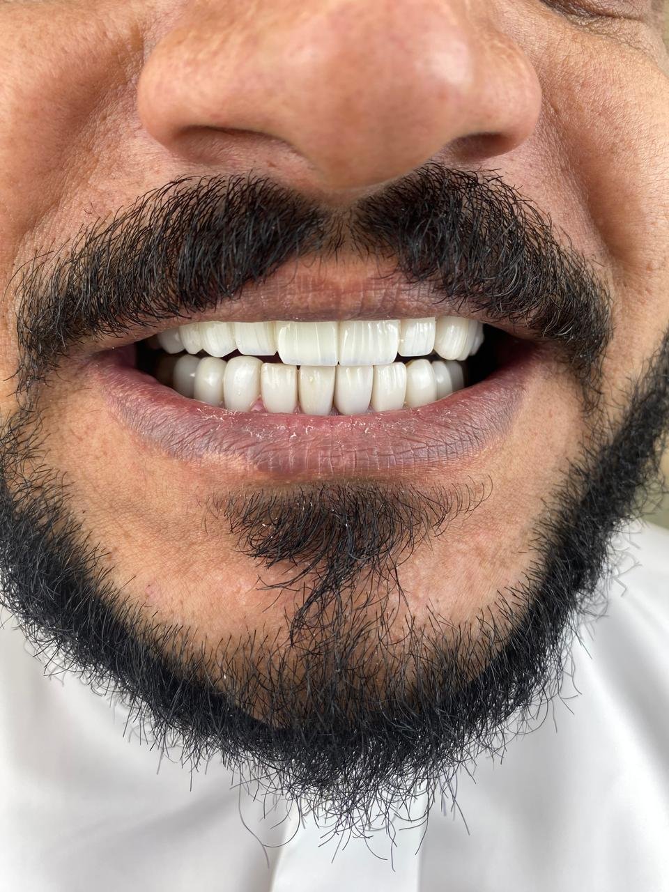 بعد ابتسامة هوليوود الكاملة
