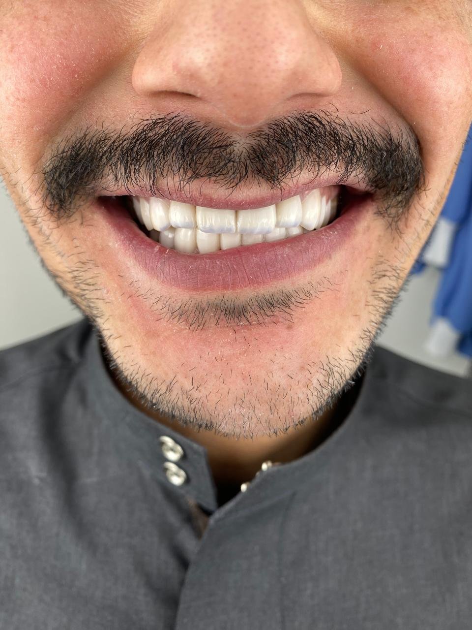بعد علاج تجميل الأسنان بالكومبوزيت