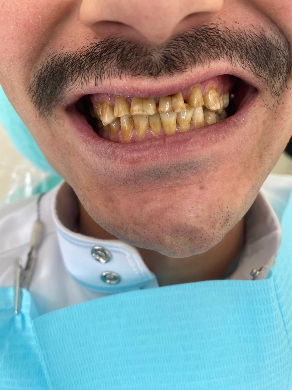 قبل علاج تجميل الأسنان بالكومبوزيت