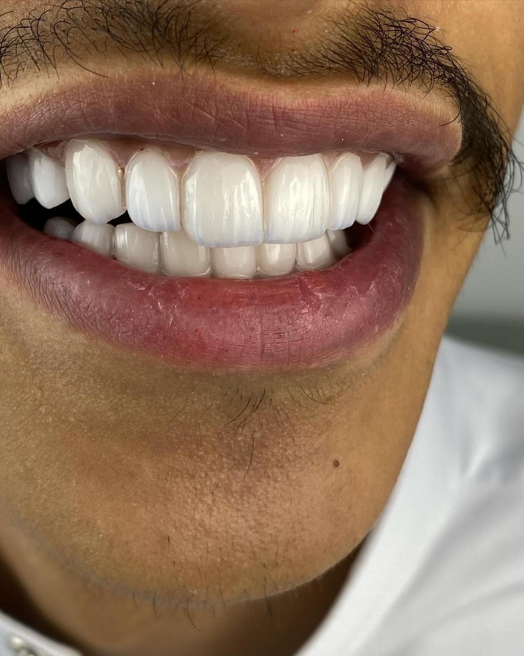 بعد علاج تبييض الأسنان والفينير