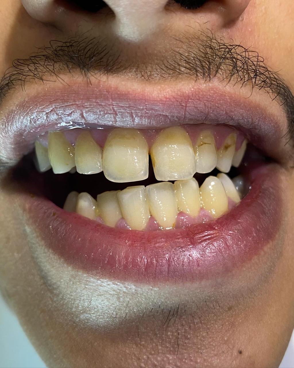 قبل علاج تبييض الأسنان والفينير