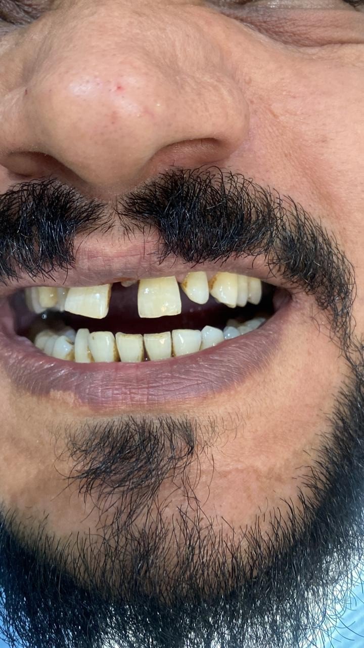 قبل ابتسامة هوليوود الكاملة